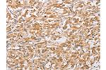 The image on the left is immunohistochemistry of paraffin-embedded Human thyroid cancer tissue using CSB-PA994683(CSGALNACT2 Antibody) at dilution 1/30, on the right is treated with fusion protein. (Original magnification: 