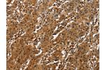 The image on the left is immunohistochemistry of paraffin-embedded Human gastic cancer tissue using CSB-PA994815(ATF4 Antibody) at dilution 1/50, on the right is treated with fusion protein. (Original magnification: 