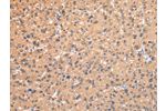 The image on the left is immunohistochemistry of paraffin-embedded Human liver cancer tissue using CSB-PA995615(AP2A1 Antibody) at dilution 1/20, on the right is treated with synthetic peptide. (Original magnification: 