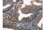 The image on the left is immunohistochemistry of paraffin-embedded Human cervical cancer tissue using CSB-PA996208(DPYSL4 Antibody) at dilution 1/15, on the right is treated with synthetic peptide. (Original magnification: 