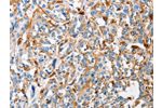 The image on the left is immunohistochemistry of paraffin-embedded Human esophagus cancer tissue using CSB-PA996311(CTSL Antibody) at dilution 1/50, on the right is treated with fusion protein. (Original magnification: 