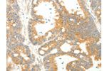 The image on the left is immunohistochemistry of paraffin-embedded Human colon cancer tissue using CSB-PA996514(AGRP Antibody) at dilution 1/20, on the right is treated with synthetic peptide. (Original magnification: 