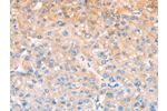 The image on the left is immunohistochemistry of paraffin-embedded Human liver cancer tissue using CSB-PA996565(CXCR4 Antibody) at dilution 1/40, on the right is treated with fusion protein. (Original magnification: 