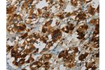 The image on the left is immunohistochemistry of paraffin-embedded Human colon cancer tissue using CSB-PA996906(FBXO32 Antibody) at dilution 1/25, on the right is treated with fusion protein. (Original magnification: 