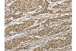 The image on the left is immunohistochemistry of paraffin-embedded Human gastic cancer tissue using CSB-PA997561(ELAC2 Antibody) at dilution 1/30, on the right is treated with fusion protein. (Original magnification: 