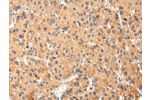 The image on the left is immunohistochemistry of paraffin-embedded Human liver cancer tissue using CSB-PA997657(ABCC1 Antibody) at dilution 1/25, on the right is treated with synthetic peptide. (Original magnification: 