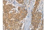 The image is immunohistochemistry of paraffin-embedded Human gastic cancer tissue using CSB-PA997710(FASTK Antibody) at dilution 1/30. (Original magnification: 