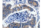 The image on the left is immunohistochemistry of paraffin-embedded Human colon cancer tissue using CSB-PA997765(GAD2  Antibody) at dilution 1/30, on the right is treated with synthetic peptide. (Original magnification: 