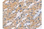The image on the left is immunohistochemistry of paraffin-embedded Human liver cancer tissue using CSB-PA997932(ERVW-1 Antibody) at dilution 1/45, on the right is treated with synthetic peptide. (Original magnification: 