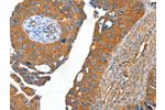 The image on the left is immunohistochemistry of paraffin-embedded Human cervical cancer tissue using CSB-PA998335(ACOT11 Antibody) at dilution 1/40, on the right is treated with fusion protein. (Original magnification: 