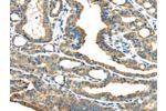 The image on the left is immunohistochemistry of paraffin-embedded Human thyroid  cancer tissue using CSB-PA998877(ERP44 Antibody) at dilution 1/35, on the right is treated with fusion protein. (Original magnification: 