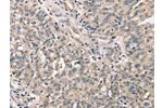 The image on the left is immunohistochemistry of paraffin-embedded Human ovarian cancer tissue using CSB-PA998940(CDK12 Antibody) at dilution 1/30, on the right is treated with synthetic peptide. (Original magnification: 