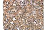 The image on the left is immunohistochemistry of paraffin-embedded Human thyroid cancer tissue using CSB-PA999004(CEACAM6 Antibody) at dilution 1/50, on the right is treated with synthetic peptide. (Original magnification: 