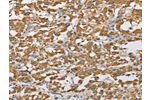 The image on the left is immunohistochemistry of paraffin-embedded Human thyroid cancer tissue using CSB-PA999330(ARHGAP25 Antibody) at dilution 1/40, on the right is treated with fusion protein. (Original magnification: 