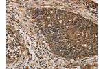 The image on the left is immunohistochemistry of paraffin-embedded Human cervical cancer tissue using CSB-PA999451(DACH1 Antibody) at dilution 1/50, on the right is treated with fusion protein. (Original magnification: 