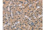 The image on the left is immunohistochemistry of paraffin-embedded Human liver cancer tissue using CSB-PA999579(ADGRB2 Antibody) at dilution 1/25, on the right is treated with synthetic peptide. (Original magnification: 