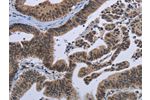 The image on the left is immunohistochemistry of paraffin-embedded Human gastic cancer tissue using CSB-PA999654(EPHA10 Antibody) at dilution 1/20, on the right is treated with fusion protein. (Original magnification: 