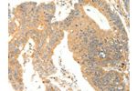 The image on the left is immunohistochemistry of paraffin-embedded Human colon cancer tissue using CSB-PA999934(AGRP Antibody) at dilution 1/20, on the right is treated with synthetic peptide. (Original magnification: 
