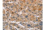 The image on the left is immunohistochemistry of paraffin-embedded Human liver cancer tissue using CSB-PA999937(CYP4A11 Antibody) at dilution 1/30, on the right is treated with fusion protein. (Original magnification: 