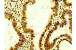 IHC image of CSB-RA010429A0HU diluted at 1:100 and staining in paraffin-embedded human colon cancer performed on a Leica BondTM system. After dewaxing and hydration, antigen retrieval was mediated by high pressure in a citrate buffer (pH 6.0). Section was