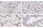 A: Adenocarcinoma of the lung with marked infiltration by CD8 positive lymphocytes.
B: Dense infiltrate of CD8 positive lymphocytes in a serous carcinoma of the ovary.
C: Clear cell kidney cancer with high number of CD8 positive lymphocytes.
D: CD8 pos