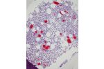 A/B Astrocytoma grade II at different magnifications, 10x (A) and 40x (B)
C Glioblastoma
D Oligoastrocytoma grade II