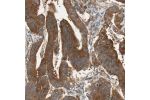 Immunohistochemical staining of human colorectal cancer shows strong cytoplasmic positivity in tumor cells.