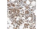 Immunohistochemical staining of human breast cancer shows strong cytoplasmic positivity in tumor cells.