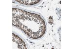 Immunohistochemical staining of human testis shows cytoplasmic positivity of cells in seminiferus ducts.
