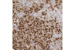 Immunohistochemical staining of human Testis cancer, carcinoma shows strong nuclear positivity in tumor cells.