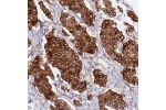 Immunohistochemical staining of human breast cancer shows strong cytoplasmic positivity in tumor cells.