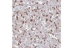 Immunohistochemical staining of human heart muscle shows distinct staining of intercalated disc in myocytes.