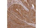 Immunohistochemical staining of human colorectal cancer shows moderate cytoplasmic positivity in tumor cells.