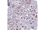 Immunohistochemical staining of human breast shows moderate membranous positivity in glandular cells.