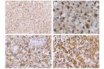 A/B Astrocytoma grade II at different magnifications, 10x (A) and 40x (B)
C Glioblastoma
D Oligoastrocytoma grade II
