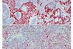 (A) Squamous cell carcinoma of the neck. 
(B) Colon carcinoma. 
(C) Chronic lymphocytic leukemia (CLL)