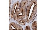 Strong apical predominance of PSA staining in a prostate cancer